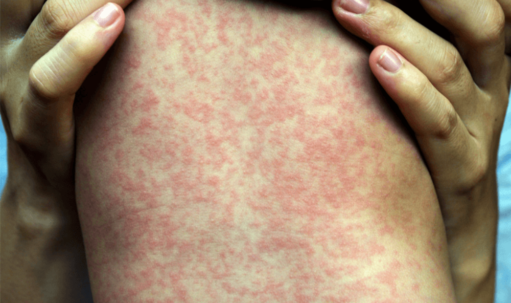 Casos de sarampión aumentan a 23 en El Salvador, confirma Salud