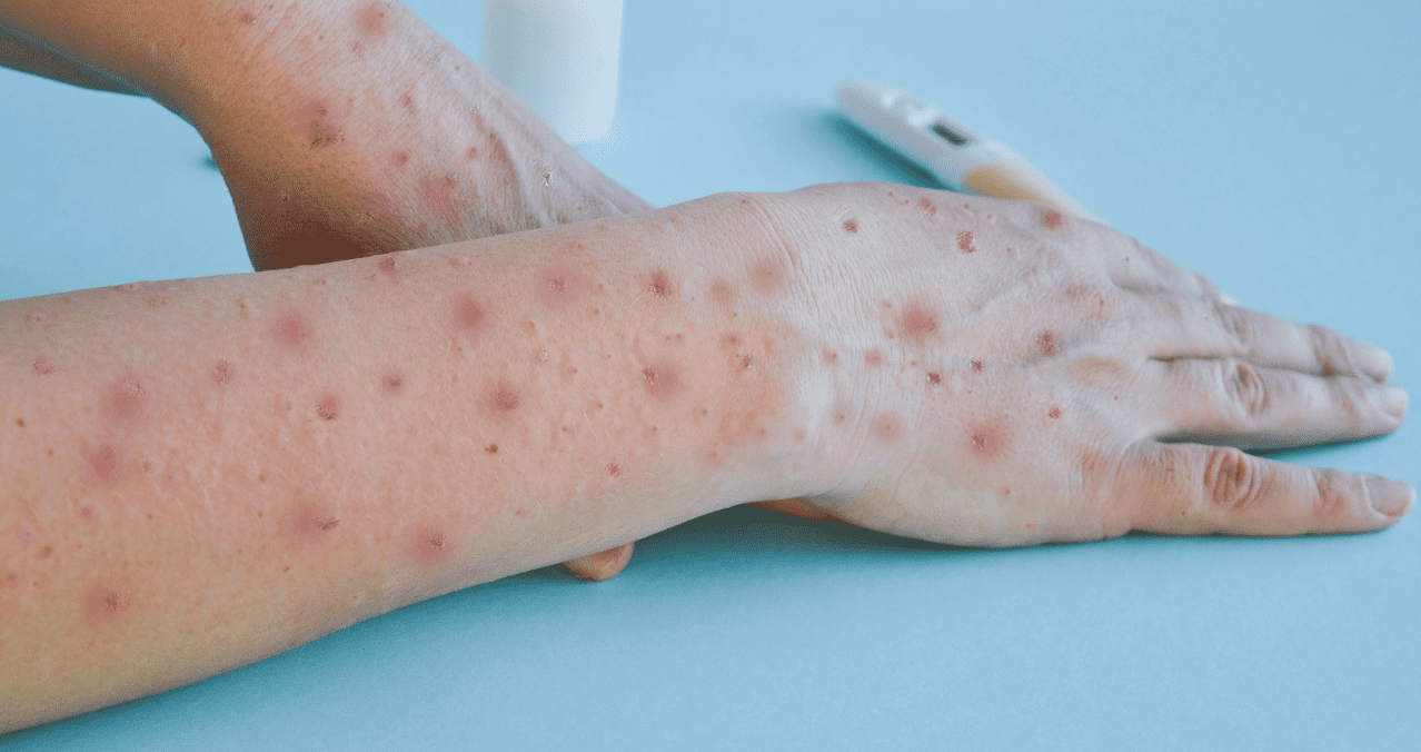Costa Rica confirma dos casos de viruela símica y activa vigilancia epidemiológica